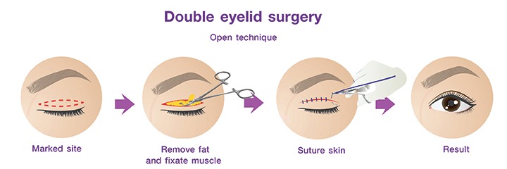 Upper eyelid surgery in Istanbul