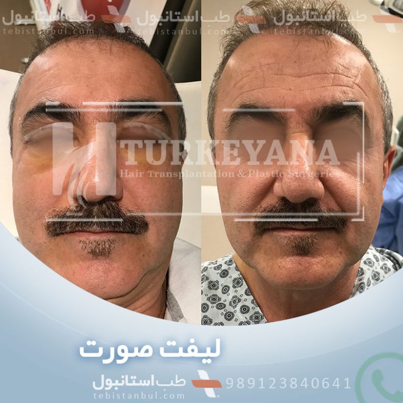 Reiseplan für eine FaceliftOperation in Istanbul 40 Tipps