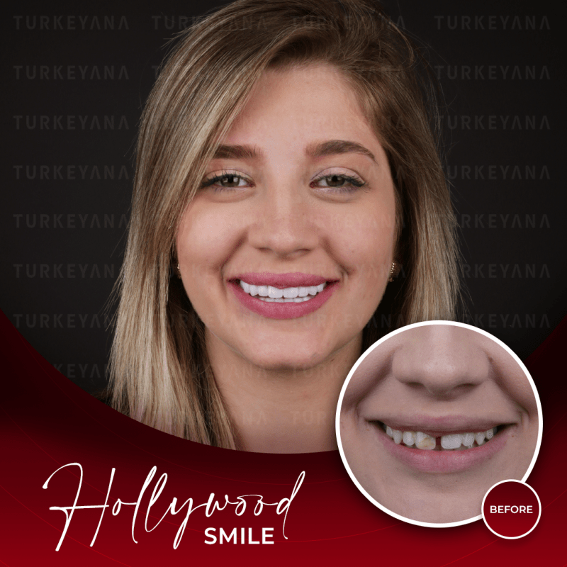 Arten von Veneers in Istanbul, Türkei bester Preis 2023 Behandlungen in Istanbul