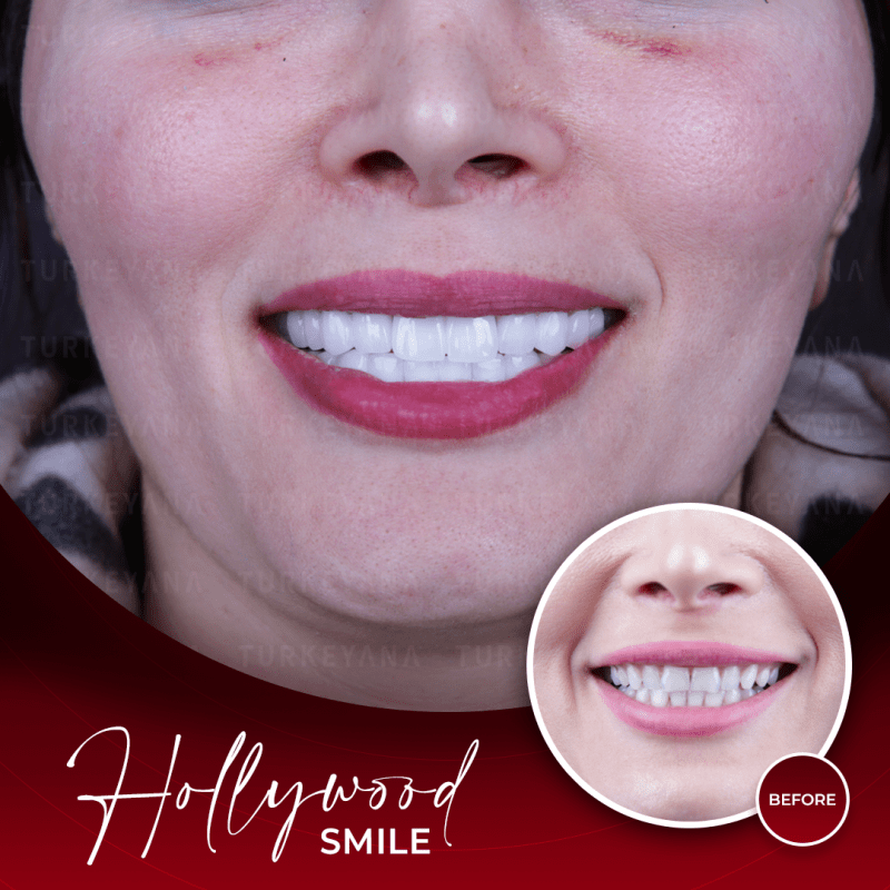 Arten von Veneers in Istanbul, Türkei bester Preis 2023