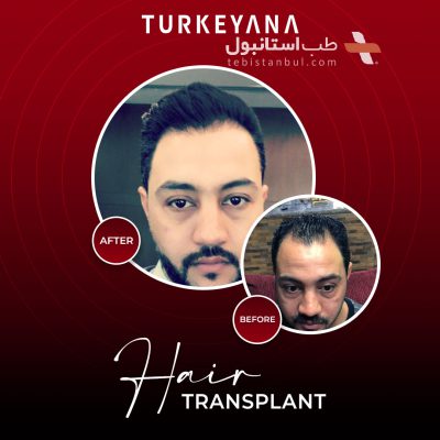 Haartransplantation in der Türkei