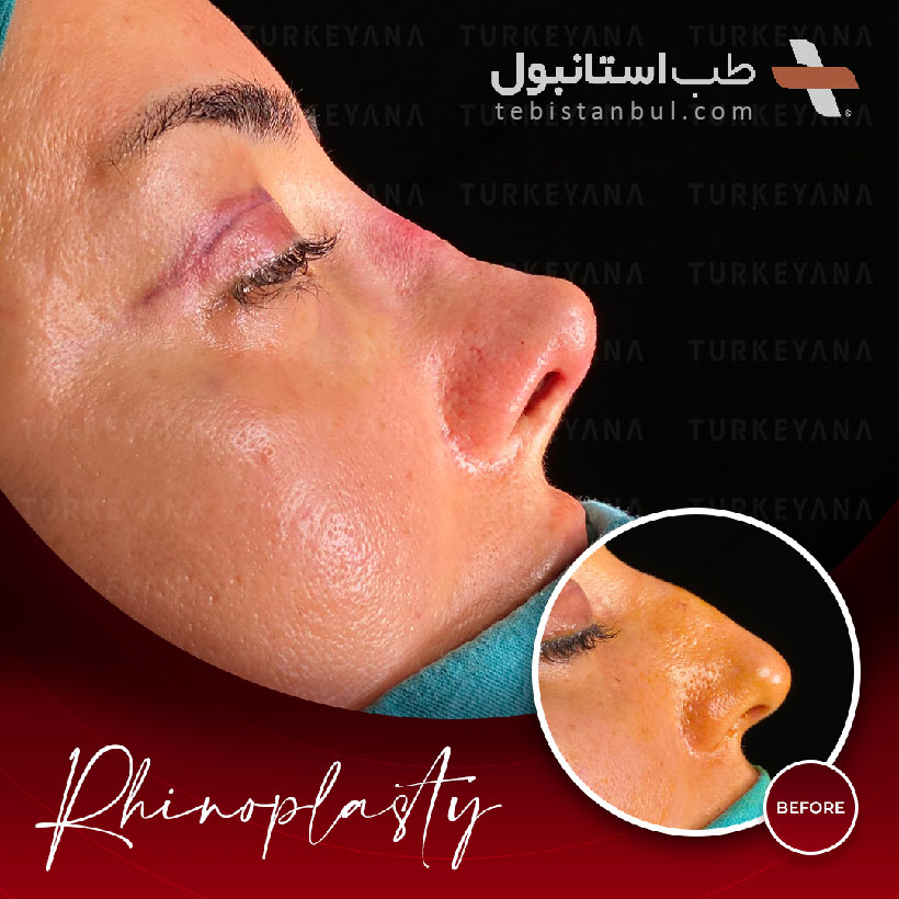 Nasenoperation in der Türkei Verfahren und Kosten in Istanbul 2023 Behandlungen in Istanbul