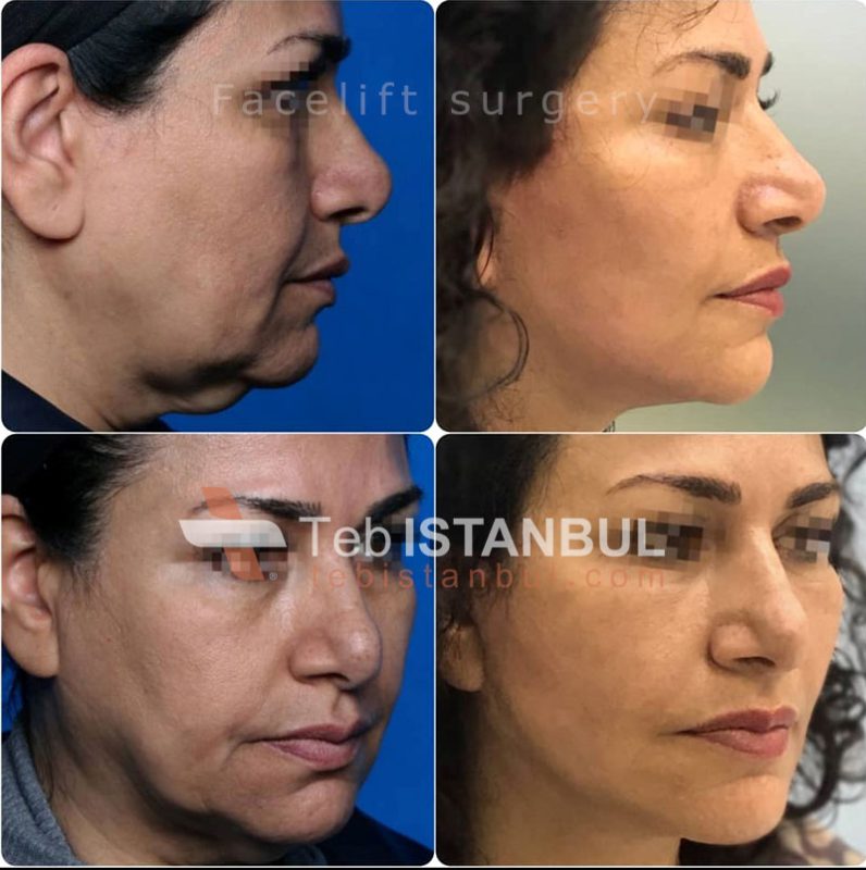 Facelift in der Türkei ️ Istanbul 2023 Beste Preise Behandlungen in