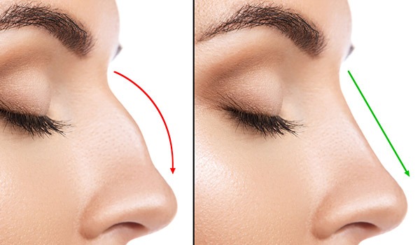 Nose Surgery in Istanbul