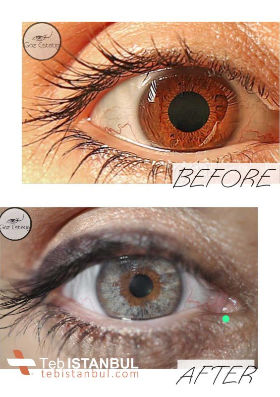 Augenfarbveränderung mit Laser