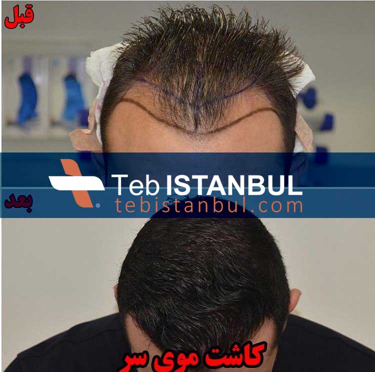 Haartransplantation in Türkiye – moderne Methoden und Preise 2023 ...