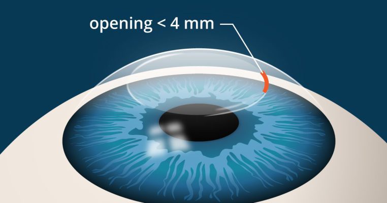 Arten der Augenoperation in Türkiye