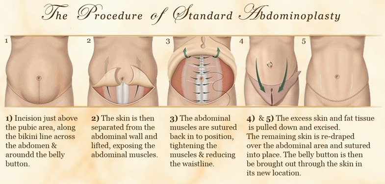 Abdominoplastik im Iran. Verfahren